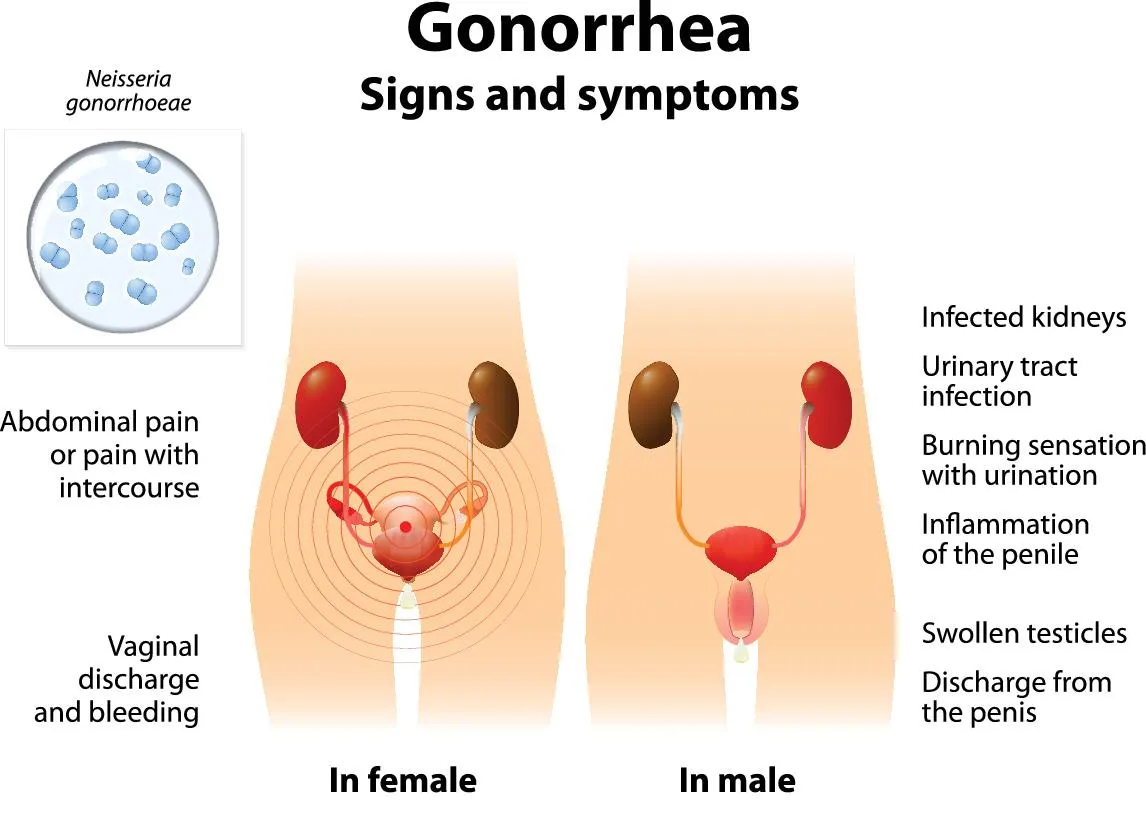 Understanding Gonorrhea: A Comprehensive Guide